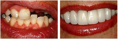 Before and after photos of dental implants for multiple missing teeth in Gainesville