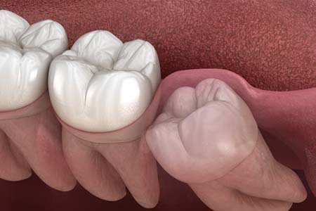 illustration of impacted wisdom tooth in Gainesville