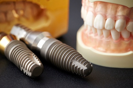 implants next to removeable implant dentures in Gainesville