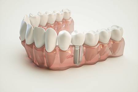 3D render of dental implant in a full arch of teeth