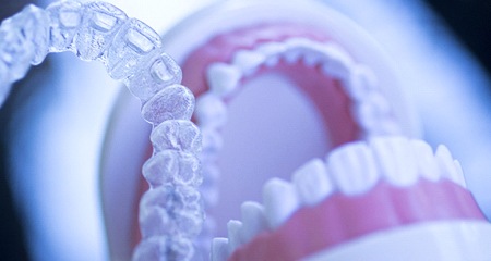 Invisalign aligners being place on a model of a mouth