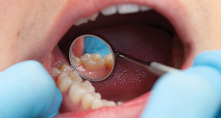 Closeup of repaired smile after metal free dental restoration