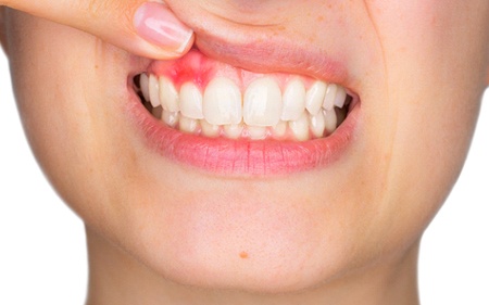 A person holding up their top lip to expose their red soft tissue due to gum disease