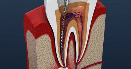 Animated root canal dissection