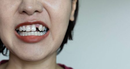 Woman with a missing tooth