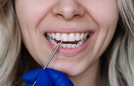 Nose-to-neck closeup of blue-gloved hand applying fluoride to woman’s teeth with small brush