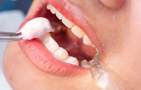 Closeup of fluoride foam applied to patient’s teeth