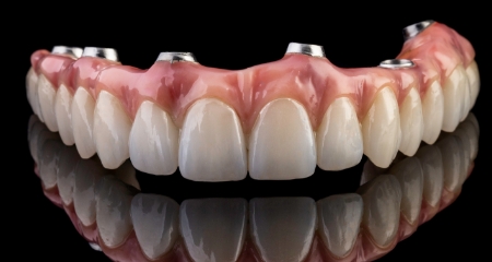 Digital illustration of all-on-4 dental implants