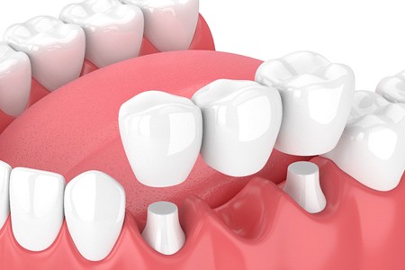 3D model of a dental crown