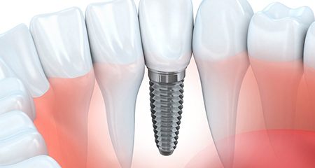 Dental Implants in Gainesville | Exceptional Dentistry & Sedation Center |  Implant Dentist