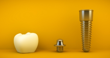 Animated dental implant supported dental crown