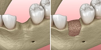 Before and after diagram of bone grafting in Gainesville