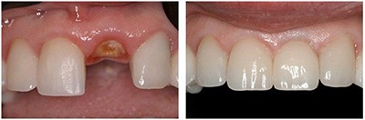 before and after photos of single tooth dental implant in Gainesville