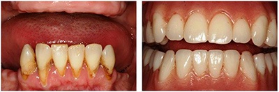 Before and after photos of implant dentures in Gainesville