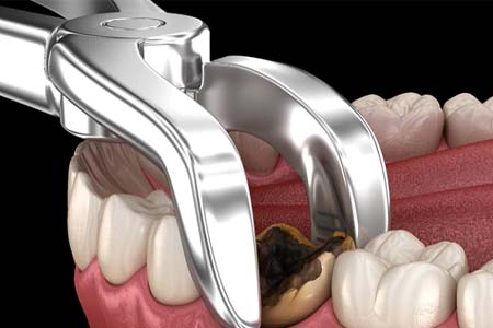 illustration of decayed tooth extraction in Gainesville