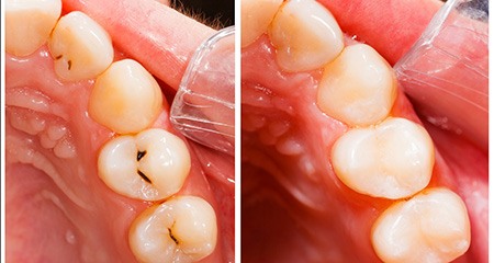 a split-screen before and after tooth-colored filling photo