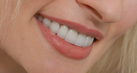 Closeup of healthy smile after fluoride treatment