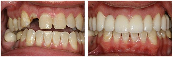 Before & After Single-Tooth Dental Implant With Porcelain Veneers