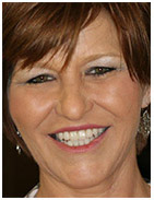 Smile after full mouth tooth replacement