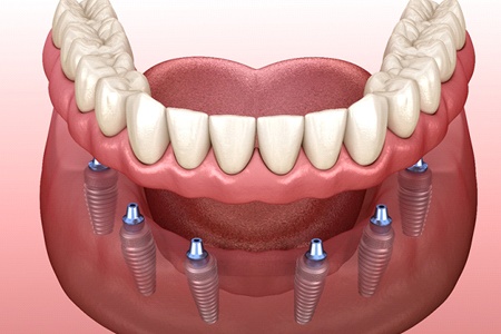 diagram of implant dentures with six implants