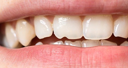 person smiling with their hand on their neck after Invisalign treatment