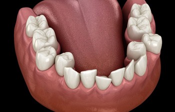 Illustration of crowded teeth