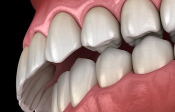 Illustration of overbite