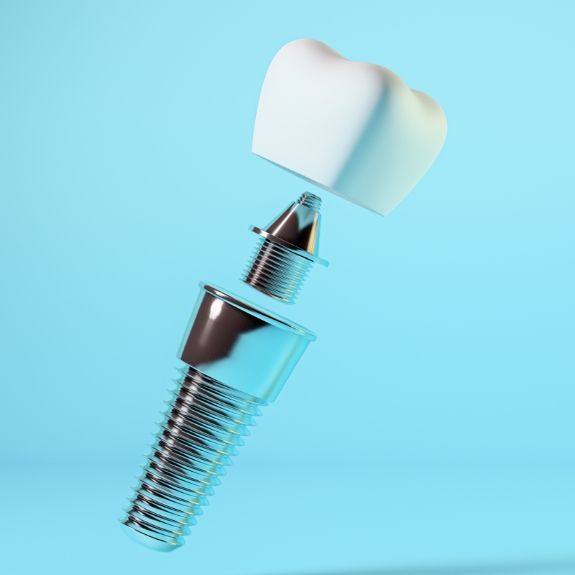 Image of tooth veneer