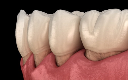 A digital image of a gum line that is receding and causing the teeth to appear longer