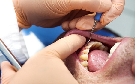 A dental professional performing a scaling and root planing procedure on a male patient