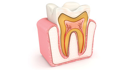 Animation of the inside of the tooth in need of root canal therapy