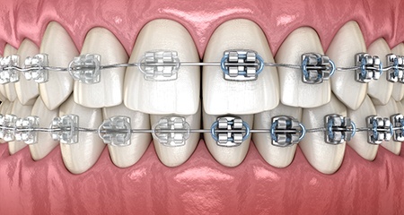 a computer illustration comparing the appearance of Six month smiles braces with traditional braces