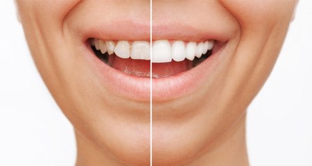 Closeup of patient's smile before and after veneers