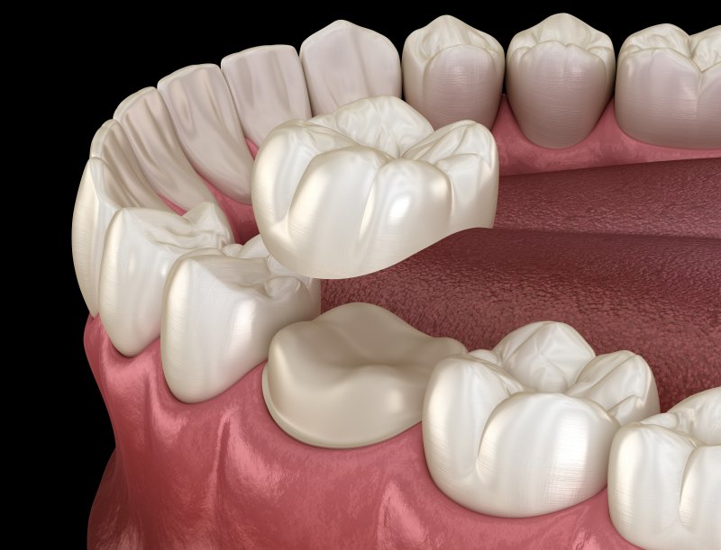3D illustration of a dental crown being placed