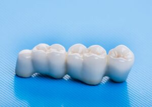 Dental bridge on a striped blue background